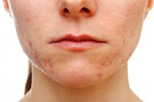 صورة: حب الشباب