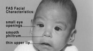 صورة: التعرف على متلازمة الجنين الكحولي