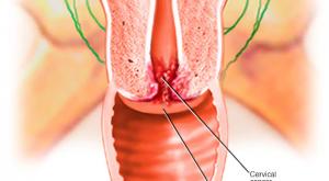 التعرف على أعراض سرطان عنق الرحم صورة: التعرف على أعراض سرطان عنق الرحم
