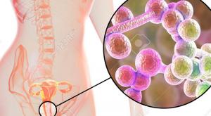 صورة: علاج التهاب المهبل الفطري