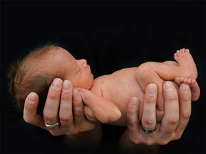 أسباب وأعراض متلازمة الطفل المرن صورة: أسباب وأعراض متلازمة الطفل المرن