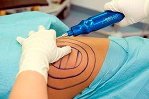 صورة: المرضى المؤهلون لاجراء عملية شفط الدهون