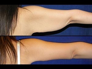 كيفية تنحيف الذراعين في اسرع وقت ممكن صورة: كيفية تنحيف الذراعين في اسرع وقت ممكن