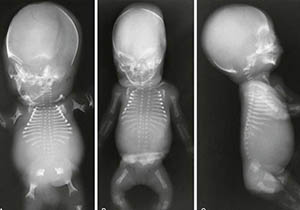 عسرات التصنع الغضروفية الهيكلية عند الأطفال صورة: عسرات التصنع الغضروفية الهيكلية عند الأطفال