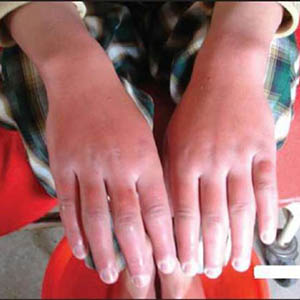 جهاز المتممة و أهم أمراضه للأطفال و الرضع صورة: جهاز المتممة و أهم أمراضه للأطفال و الرضع