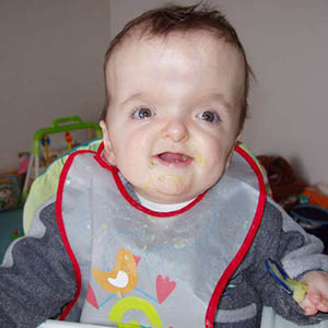 أعراض متلازمة شدياق هيغاشي و طرق علاجها صورة: أعراض متلازمة شدياق هيغاشي و طرق علاجها