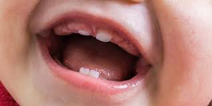 مراحل ظهور الأسنان عند الأطفال بالترتيب صورة: مراحل ظهور الأسنان عند الأطفال بالترتيب