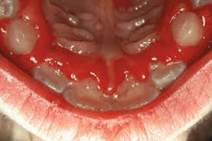 التهاب اللثة عند الأطفال Gingivostomatitis صورة: التهاب اللثة عند الأطفال Gingivostomatitis