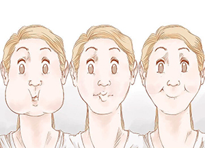 علاجات طبية ومنزلية لتنحيف الوجه السمين صورة: علاجات طبية ومنزلية لتنحيف الوجه السمين