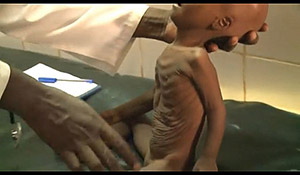 ماذا يجب ان تعرف عن المرازمس الذي يصيب الاطفال صورة: ماذا يجب ان تعرف عن المرازمس الذي يصيب الاطفال