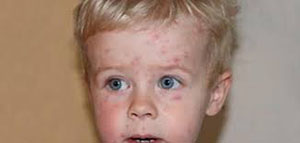 الأرق عند الأطفال صورة: الأرق عند الأطفال