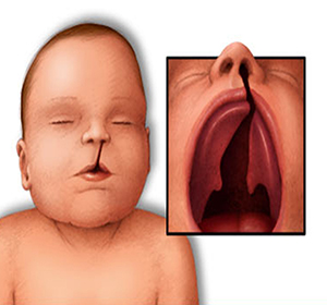 ماهي متلازمة دي جورج عند الرضع والاطفال ؟ صورة: ماهي متلازمة دي جورج عند الرضع والاطفال ؟