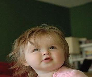 اعراض متلازمة وليامز صورة: اعراض متلازمة وليامز