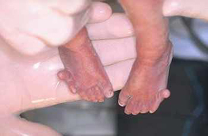 أسباب وأعراض متلازمة باتو لدى الأطفال صورة: أسباب وأعراض متلازمة باتو لدى الأطفال