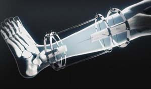 دراسة جديدة تؤكد ان جراحات انقاص الوزن تسبب هشاشة العظام صورة: دراسة جديدة تؤكد ان جراحات انقاص الوزن تسبب هشاشة العظام