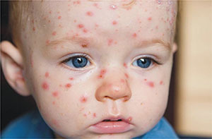 صورة: اسباب حمى الرضع