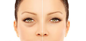 صورة: انتفاخ تحت العين: الأسباب والعلاج