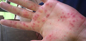 أسباب ظهور الحبوب تحت الجلد ونصائح للعلاج صورة: أسباب ظهور الحبوب تحت الجلد ونصائح للعلاج