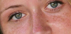 الفرق بين الكلف والنمش و نصائح صورة: الفرق بين الكلف والنمش و نصائح