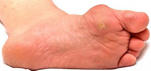 مسمار العظم و أعراض مسمار العظم و أسباب الإصابة بمسمار العظم صورة: مسمار العظم و أعراض مسمار العظم و أسباب الإصابة بمسمار العظم