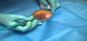 أعراض وعلامات الإصابة بكيس الشعر و الأشخاص الأكثر عرضة للإصابة بكيس الشعر صورة: أعراض وعلامات الإصابة بكيس الشعر و الأشخاص الأكثر عرضة للإصابة بكيس الشعر