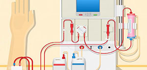 صورة: غسيل الكلى و أسباب غسيل الكلى و أنواع غسيل الكلى