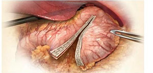 صورة: عملية تكميم المعدة و ما بعد عملية تكميم المعدة