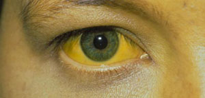 أسباب اصفرار العين و فيديو عن اصفرار العين صورة: أسباب اصفرار العين و فيديو عن اصفرار العين