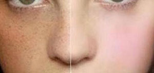 صورة: الكلف و الفئات المعرضة للإصابة بالكلف