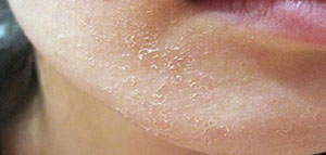 هل لجفاف الوجه علاقة بتوعك المعدة صورة: هل لجفاف الوجه علاقة بتوعك المعدة