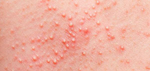 صورة: حبوب صغيرة في الجسم