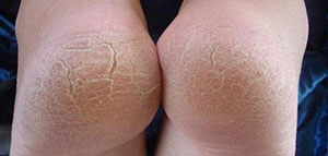 صورة: تشقق القدمين و أسباب تشقق القدمين و علاج تشقق القدمين