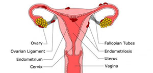 بطانة الرحم المهاجرة و أعراض بطانة الرحم المهاجرة صورة: بطانة الرحم المهاجرة و أعراض بطانة الرحم المهاجرة