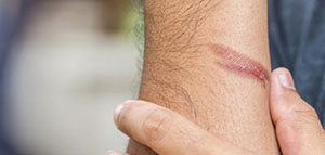 صورة: أفضل الكريمات الطبية التي تزيل آثار الحروق