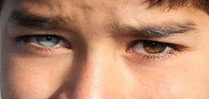 العيوب الخلقية للعين و أنواع العيوب الخلقية للعين صورة: العيوب الخلقية للعين و أنواع العيوب الخلقية للعين