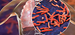 صورة: الدرن وانتقاله و أعراض الدرن و علاج الدرن