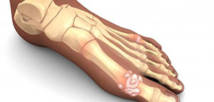 هشاشة العظام و كسور العظام و انحراف العمود الفقري جانبيا صورة: هشاشة العظام و كسور العظام و انحراف العمود الفقري جانبيا