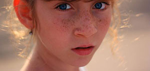 الكلف و علاج الكلف طبيا و علاج الكلف طبيعيا صورة: الكلف و علاج الكلف طبيا و علاج الكلف طبيعيا