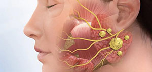 صورة: سرطان الغدد اللعابية و هل يصيب السرطان جميع أنواع الغدد اللعابية