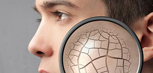 التشققات الجلدية و علاج التشققات الجلدية صورة: التشققات الجلدية و علاج التشققات الجلدية