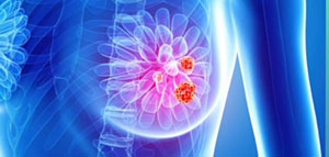 صورة: ظهور كتل بالثدي و أسباب ظهور كتل بالثدي