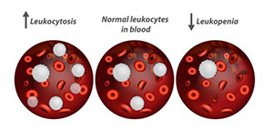 صورة: أنواع ارتفاع كريات الدم البيضاء و أعراض ارتفاع كريات الدم البيضاء