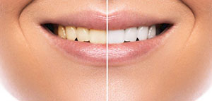 صورة: تبييض الأسنان: الطرق الفعّالة والنصائح للحفاظ على البياض