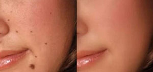 صورة: طرق فعالة لإزالة الشامة من الوجه