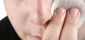 الرؤوس السوداء و طرق إزالة الروؤس السوداء صورة: الرؤوس السوداء و طرق إزالة الروؤس السوداء