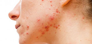 طريقة إزالة آثار حب الشباب صورة: طريقة إزالة آثار حب الشباب