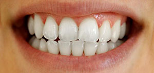 تبييض الأسنان و أعشاب لتبييض الأسنان صورة: تبييض الأسنان و أعشاب لتبييض الأسنان