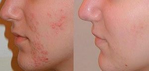 حب الشباب و وصفات لإزالة حب الشباب وآثاره عن البشرة صورة: حب الشباب و وصفات لإزالة حب الشباب وآثاره عن البشرة