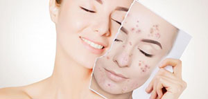 صورة: البنزويل بيروكسايد و خل التفاح و التقشير الكيميائي