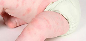 صورة: حساسية الأطفال و علاج طبيعي للحساسية عند الأطفال